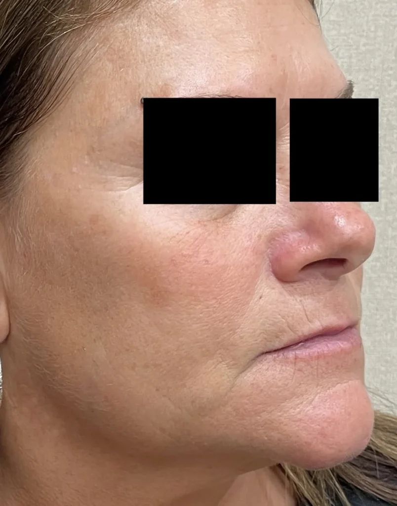 DermaV browns right after