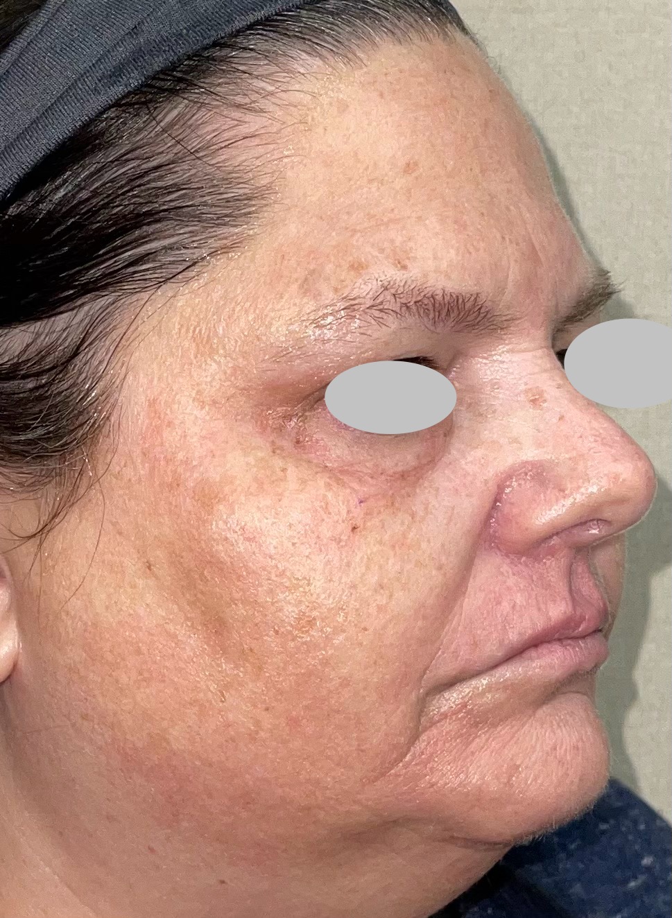 Laser Skin Treatments In Chaska Hutchinson Darabi Dermatology laser-skin-treatments-in-chaska-hutchinson-darabi-dermatology