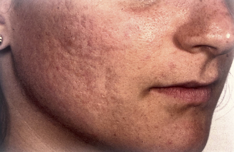 Accutane-After