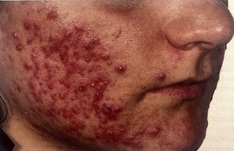 Accutane-Before