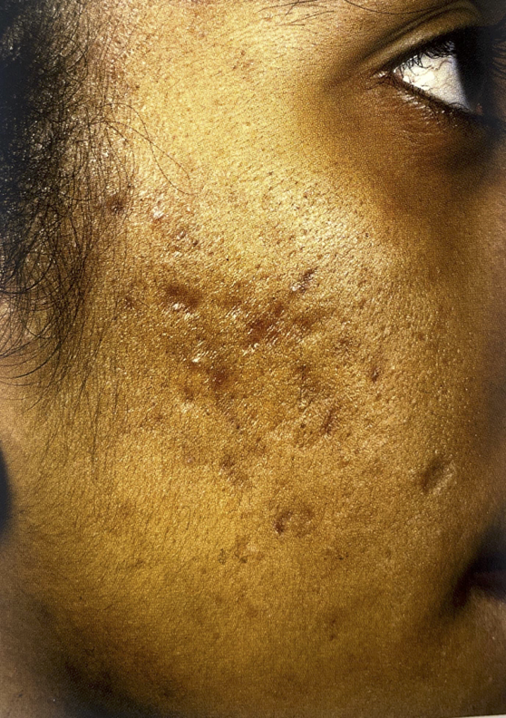 Acne-Scarring