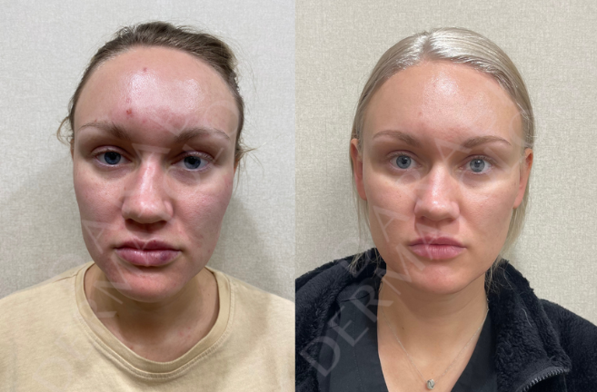Before-after-salycilic-acid