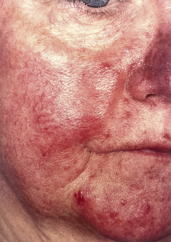 Rosacea