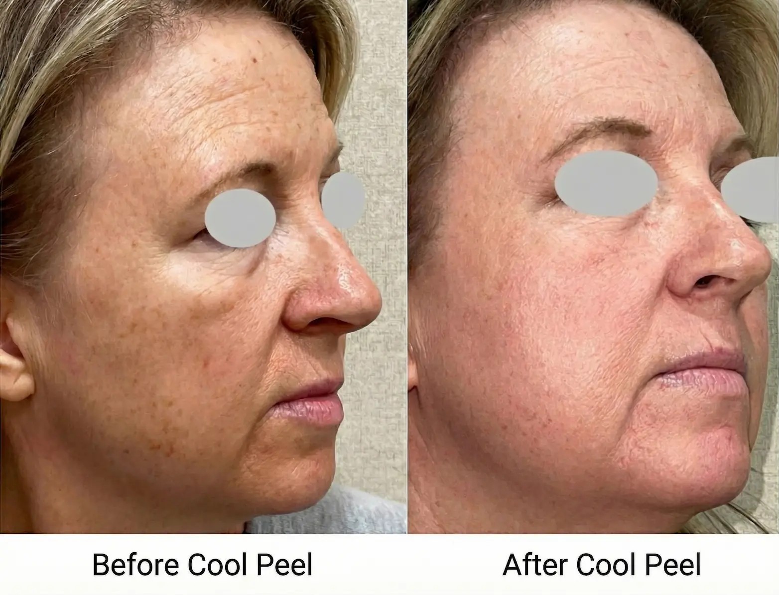 Improve texture, tone and underlying structure with lasers & energy-based treatments