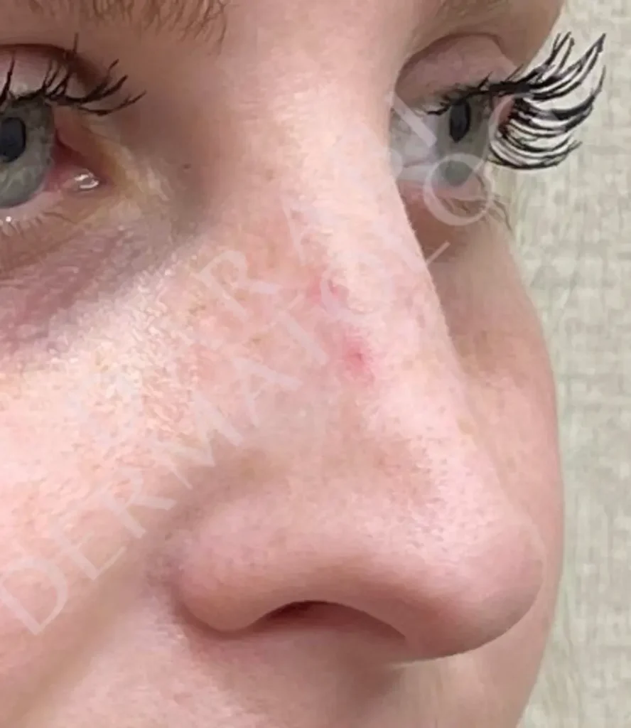 Angioma-side-nose-after-DermaV-WATERMARK
