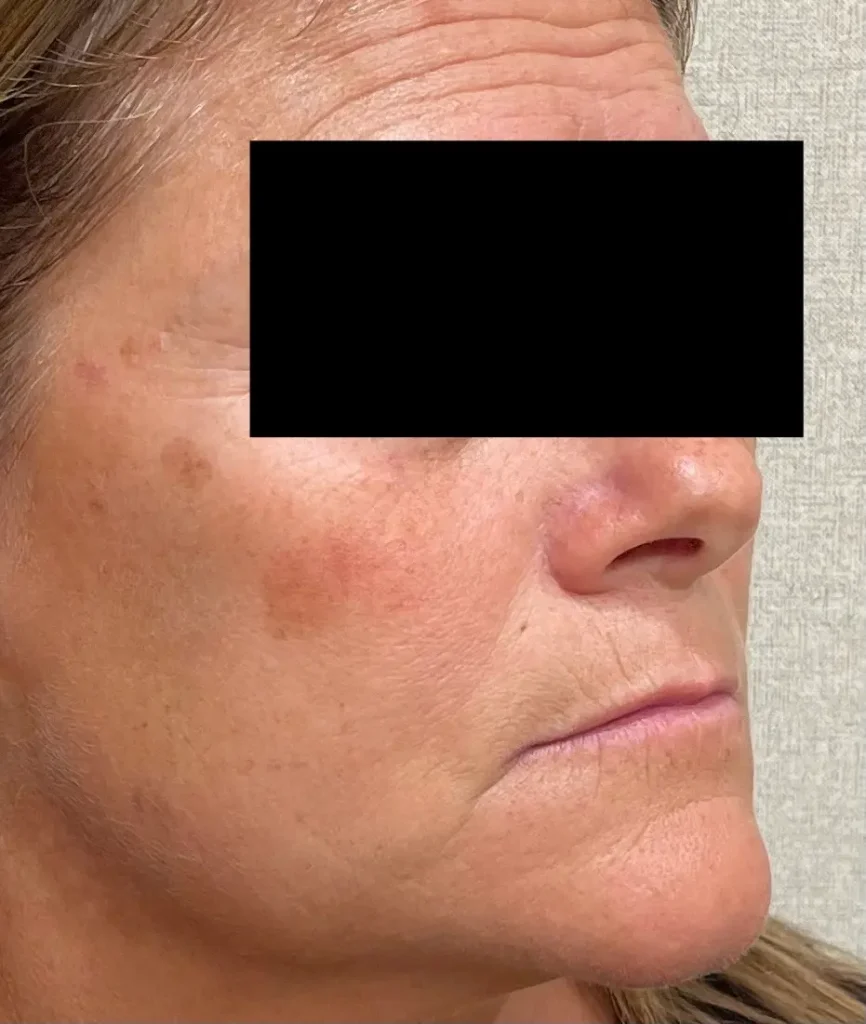 DermaV-browns-right-before