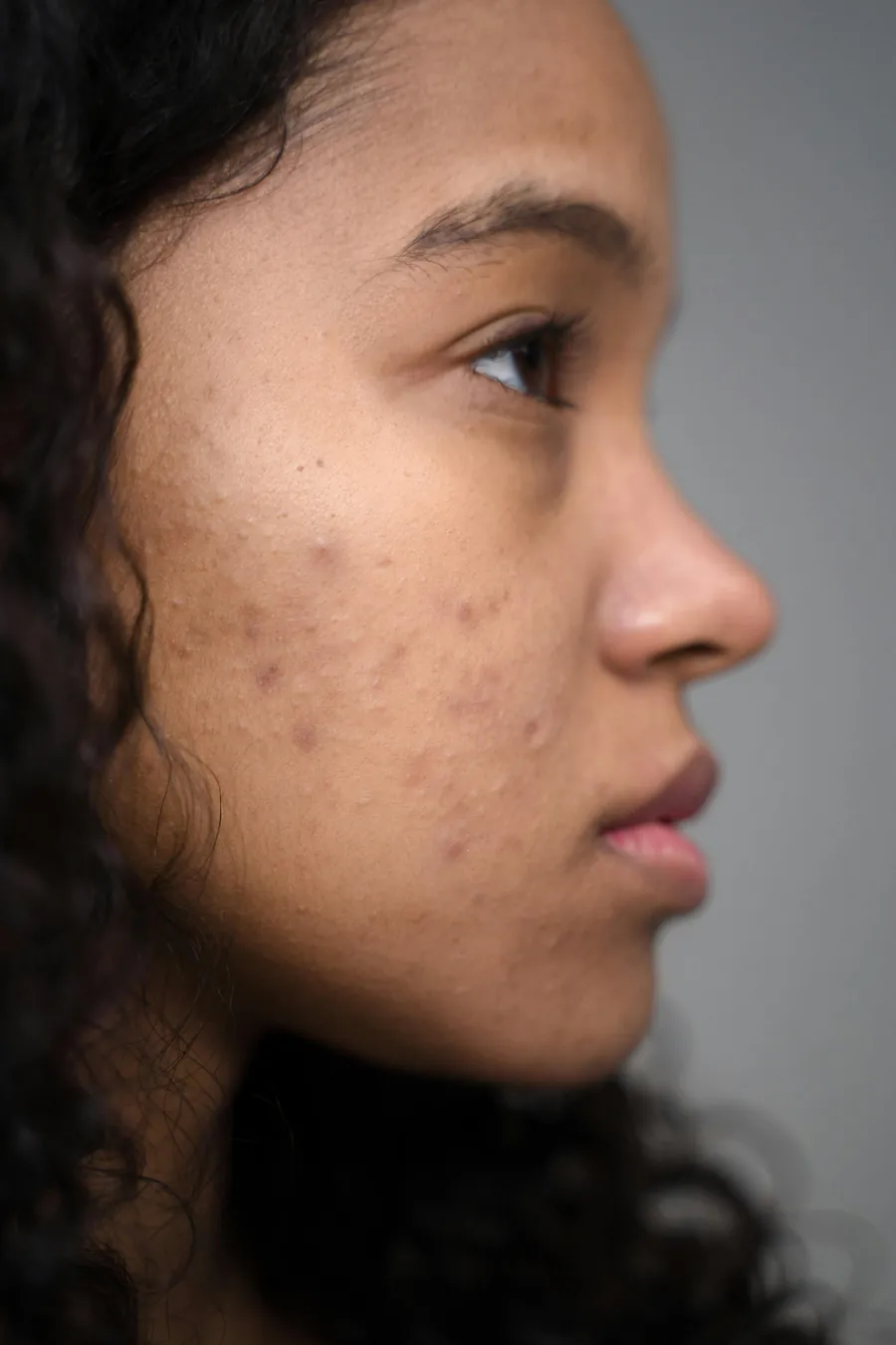 Acne