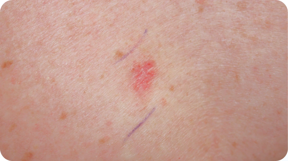 Basal Cell Carcinoma (BCC)