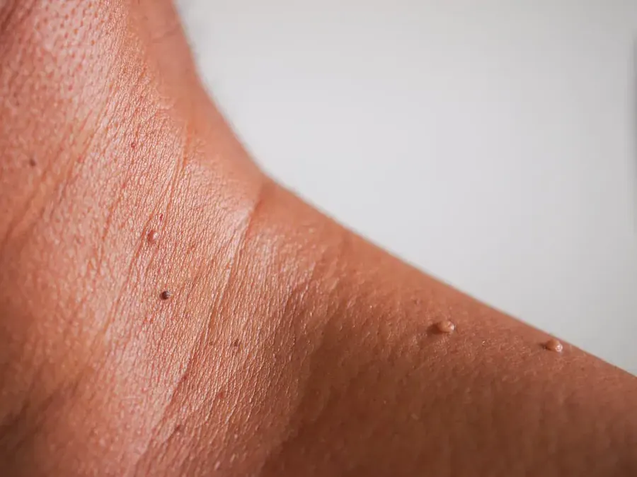 Benign Skin Growths