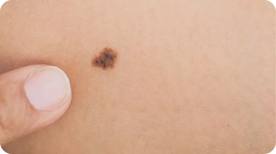 Melanoma