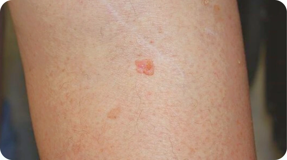 Squamous Cell Carcinoma (SCC)