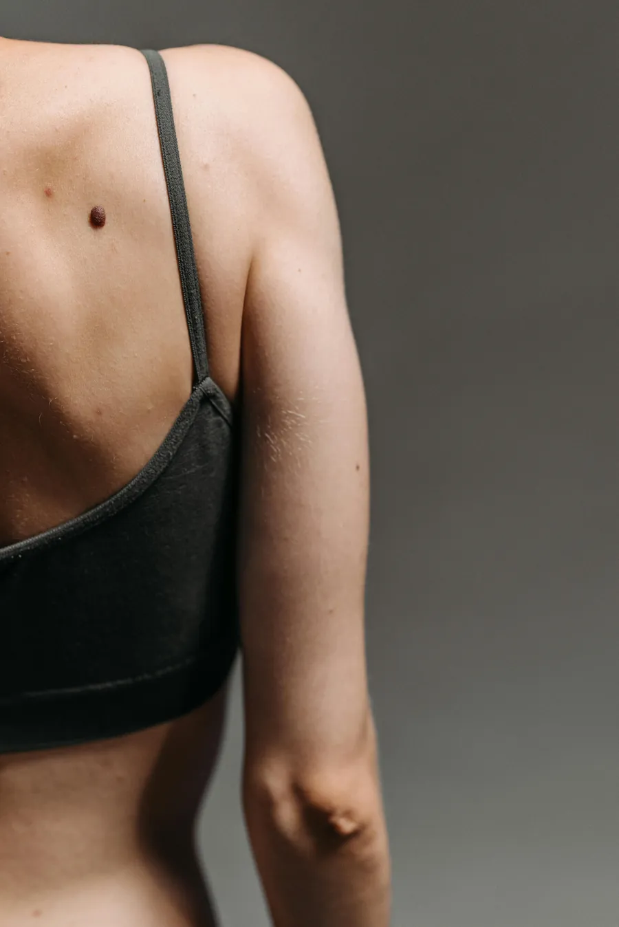 Skin Cancer & Suspicious Moles